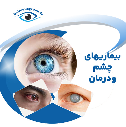 بیماری های چشم و درمان